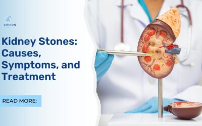 Kidney Stones: Causes, Symptoms, and Treatment